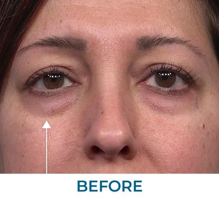 Karen before using Rapid Reduction Serum