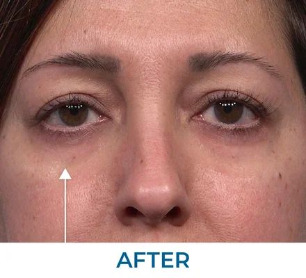 Karen after using Rapid Reduction Serum