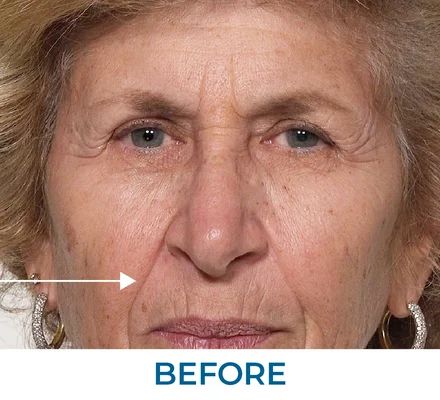 James before using Rapid Reduction Serum