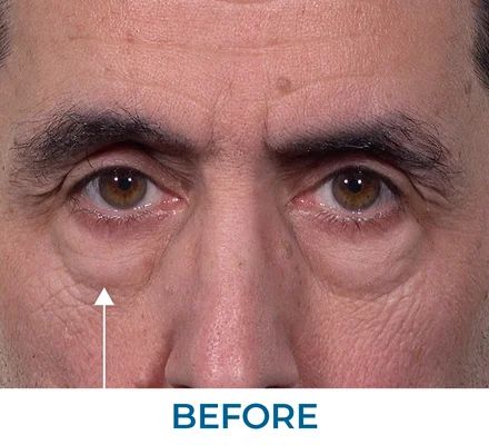Linda before using Rapid Reduction Serum