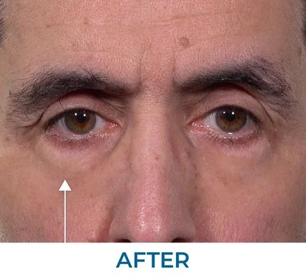 Linda after using Rapid Reduction Serum