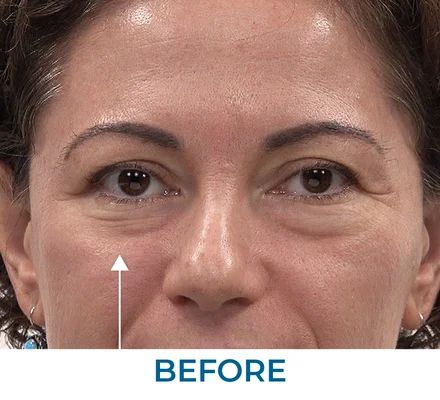 Patricia before using Rapid Reduction Serum