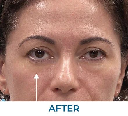 Patricia after using Rapid Reduction Serum