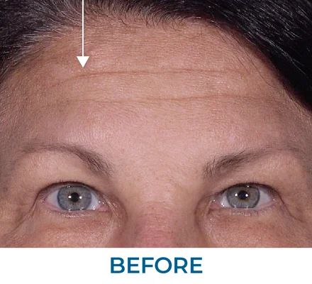 Charles before using Rapid Reduction Serum
