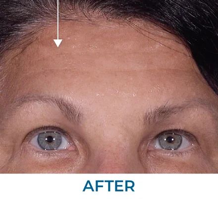 Charles after using Rapid Reduction Serum