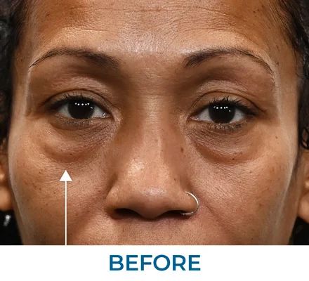 Ritchie before using Rapid Reduction Serum