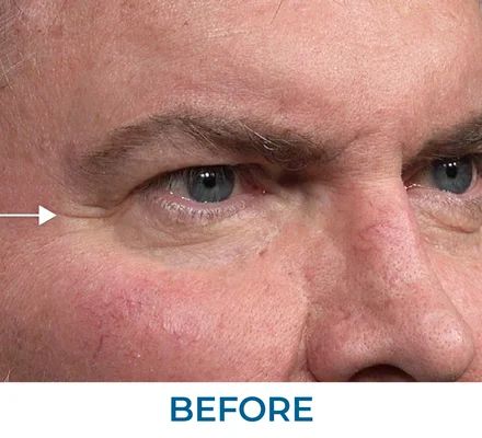 Susan before using Rapid Reduction Serum