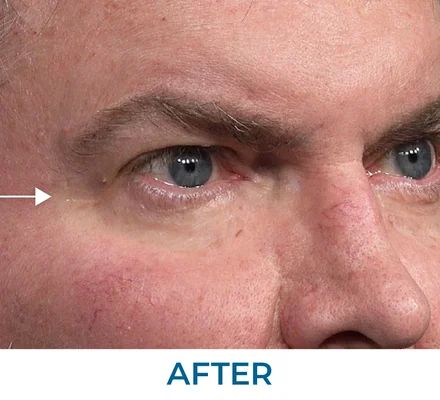 Susan after using Rapid Reduction Serum